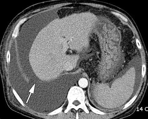 Thoracic Complications Of Liver Cirrhosis Radiologic Findings