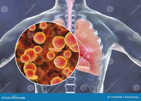 Bacterias De Los Pneumoniae Del Micoplasma En Pulmones Humanos Stock De