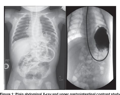 Acute Gastric Volvulus And Congenital Diaphragmatic Hernia Case Report And Review Semantic