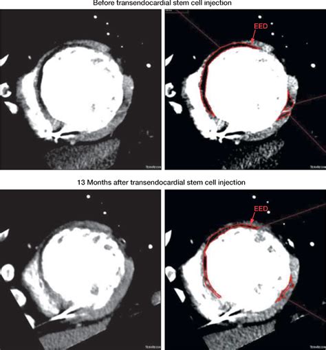 Comparison Of Allogeneic Vs Autologous Bone Marrowderived Mesenchymal