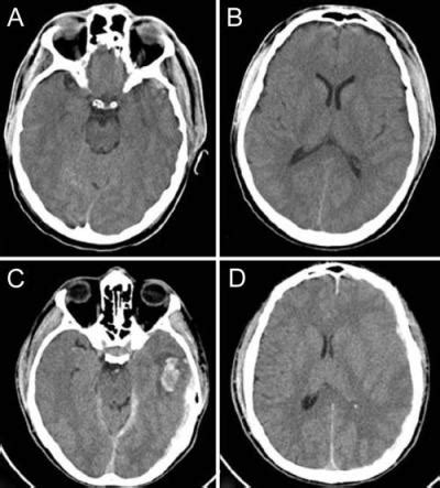 cerebral contusion | Neurosurgery Blog