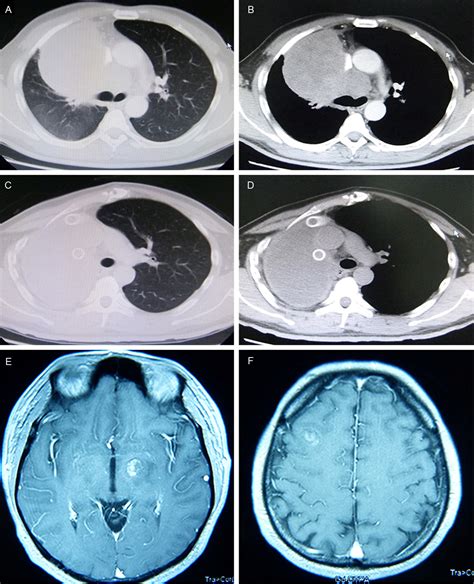 Figure 1 From Hepatoid Adenocarcinoma Of The Lung A Case Report