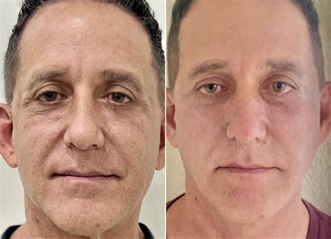 Dermal Fillers Before And After Pictures Client Tampa Bay North