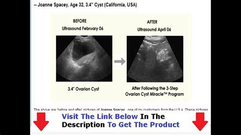 Ovarian Cyst Miracle Honest Review Bonus Discount Youtube