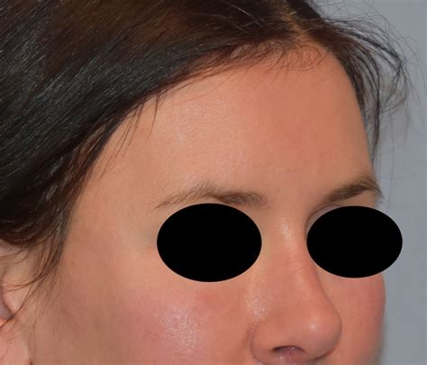 Female Custom Forehead Temporal Implant Oblique 1 DR Barry Eppley