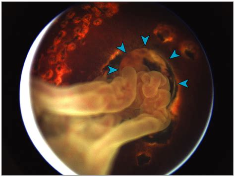 Recurrent Closed Funnel Retinal Detachment Associated With Optic Nerve