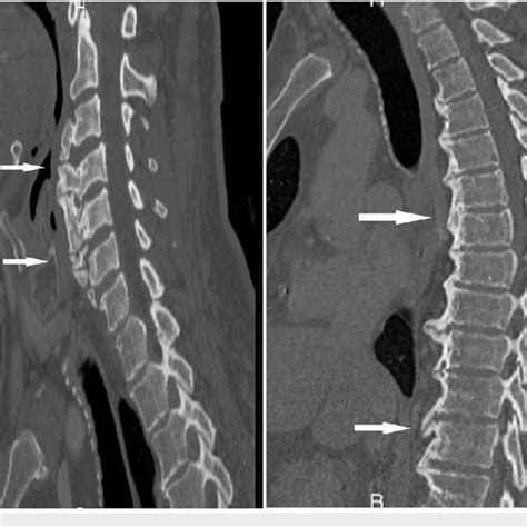 Preoperative Sagittal Cervical And Thoracic Computed Tomography Ct