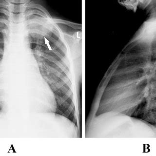 Aeb The Anterior Posterior And Lateral Chest Radiography Shows A Mass