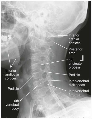 Skeletal 17 Critique Oblique Spine Projections Flashcards Quizlet