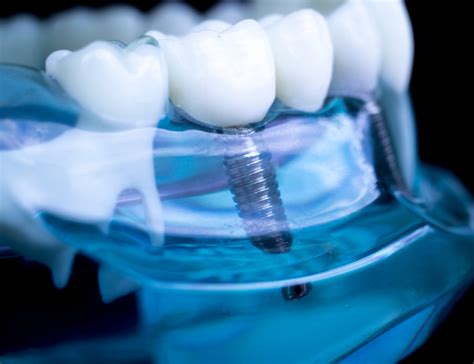 Tecnolog A Y Tipos De Implantes Dentales Innovaci N En La