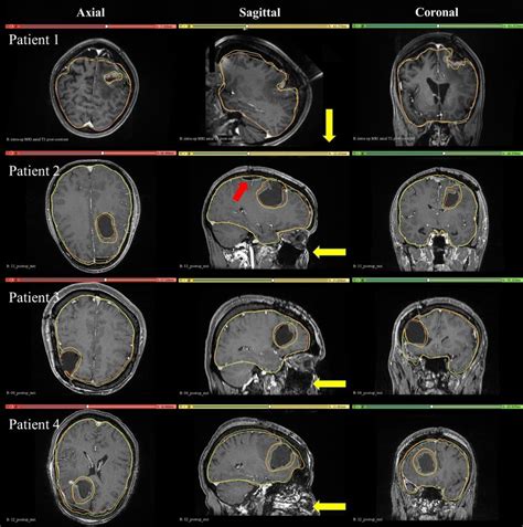 Intra Operative Patient 1 And Post Operative Patient 2 3 And 4