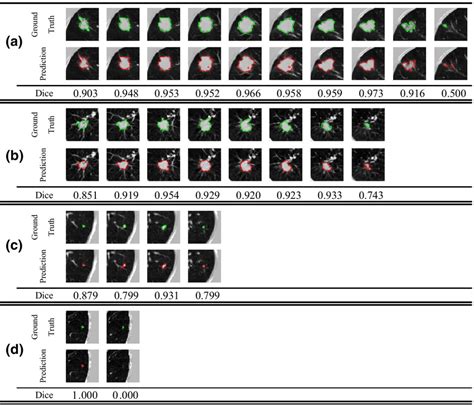 Segmentation Results Of Lung Nodules With Different Sizes By 3D Res