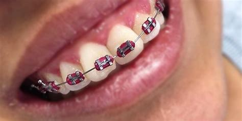 red-braces-color – Braces Explained