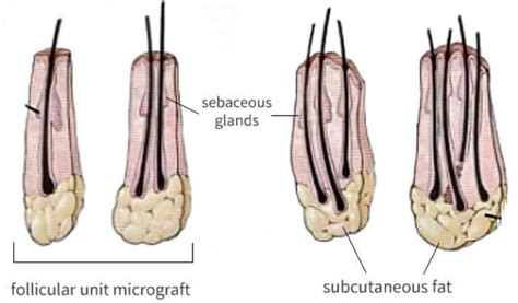 Beard Transplant: Everything You Need to Know (and More)