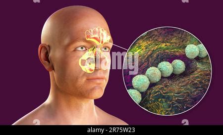 Streptococcus Pyogenes Bacteria As A Cause Of Sinusitis Computer