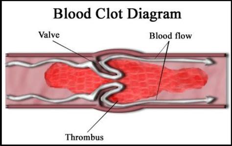 What causes blood clots? – What causes this?