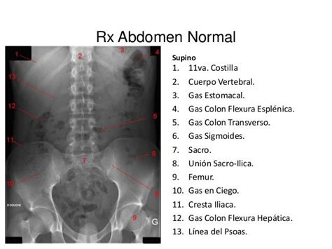 Guia Paso A Paso Para Interpretar Una Radiografia De Abdomen Themeloader