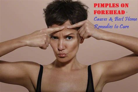 Pimples on Forehead - Causes & Best Home Remedies to Cure - Stylish Walks