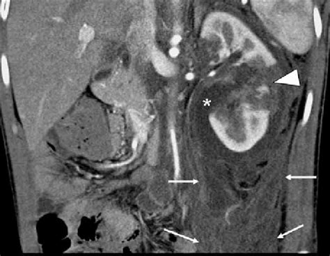 Shows A Grade Iv Trauma Of The Left Kidney With Multifragmentary Renal