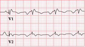 Atrial Enlargement And Ventricular Hypertrophy Ekg Essentials A