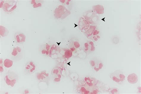 The Brief Case A Case Of Primary Amebic Meningoencephalitis Pam After Exposure At A Splash