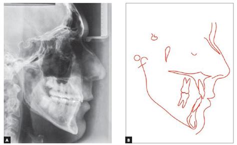 Scielo Brasil Orthodontic Treatment As An Adjunct To Periodontal