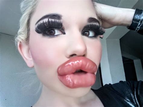 Real Life Barbie Shows Off Giant Lips After Th Filler Injection