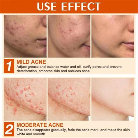 How To Calm Inflamed Skin On Face Edu Svet Gob Gt