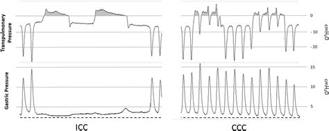 Gastric Insufflation During Cardiopulmonary Resuscitation A Study In