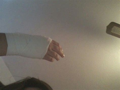 Sprained wrist:( | Sprained wrist, Sprain, Wrist