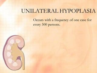 Renal Hypoplasia FINAL OUTPUT by Nica Valencia | PPT