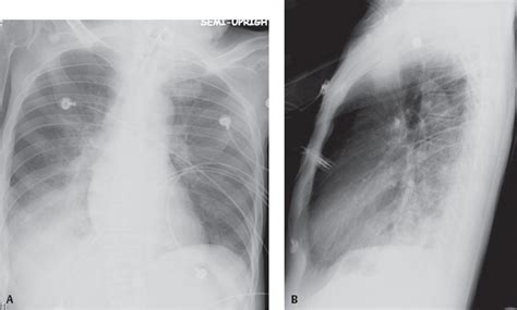 53 Pseudomonas Pneumonia | Radiology Key