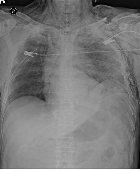 Chest Anteroposterior View Radiograph Shows Elevated Left Diaphragm And