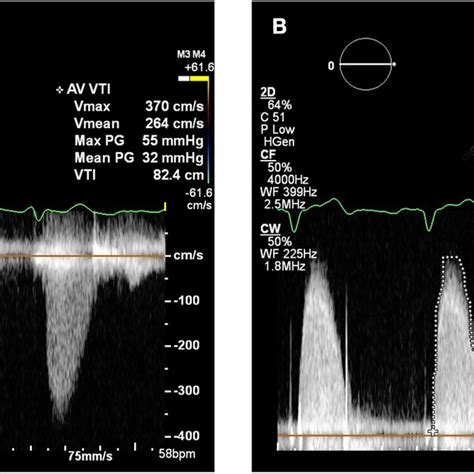 Transthoracic Echocardiogram August 2018 Continuous Wave Doppler In