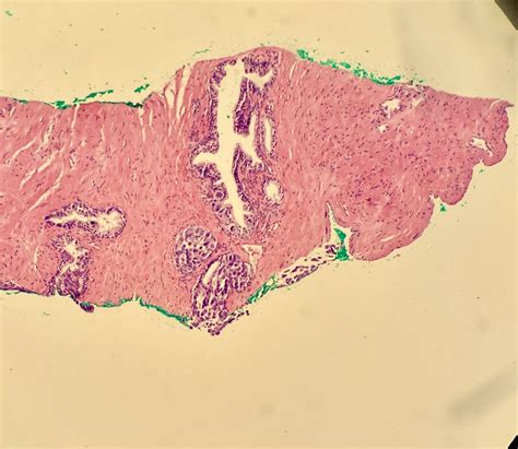 David Cohen Md On Twitter Prostate Treachery Pagetoid Spread Of Urothelial Carcinoma In Situ