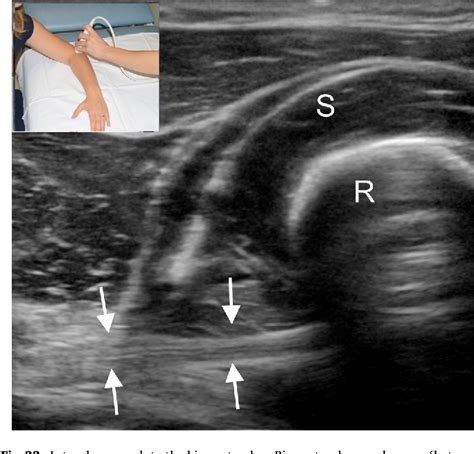 Figure 2 From Ultrasound Of The Elbow With Emphasis On Detailed