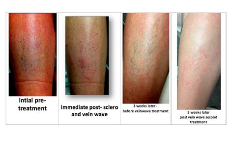 Before After Amazing Vein Treatments At MIMIT In Chicago Veins