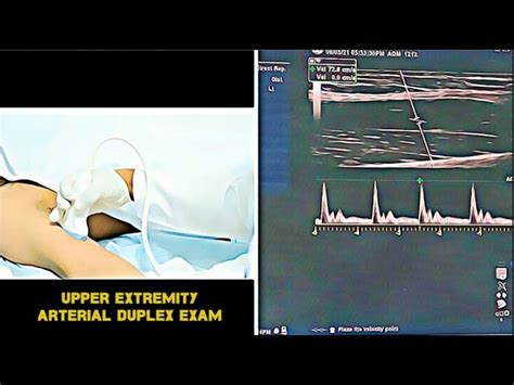 Lower Extremity Venous Duplex Ultrasound Chronic Venous 47 Off