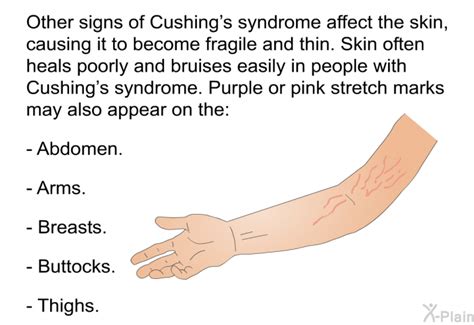 Cushings Syndrome