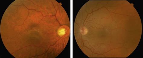 Epiretinal Membrane | Ento Key