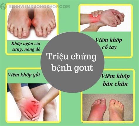 Nhận biết sớm dấu hiệu bệnh Gout giúp điều trị hiệu quả hơn Trung tâm