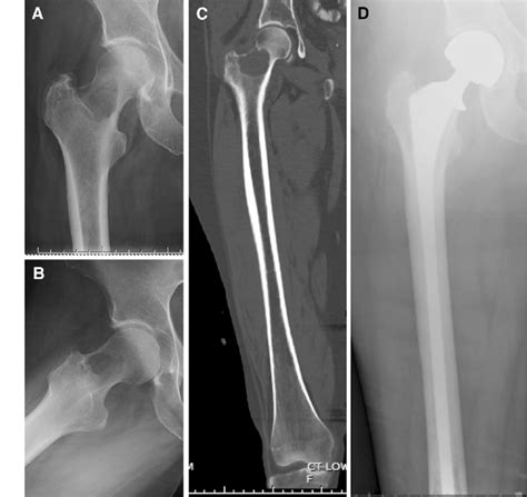 Standard treatment for impending or actual femoral neck fracture. This... | Download Scientific ...