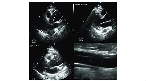 Echocardiogram that shows dilated aortic root (5 cm), intimal flapping ...