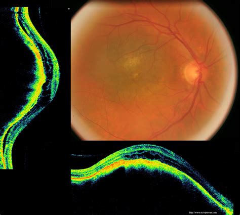 Rétines malades et OCT