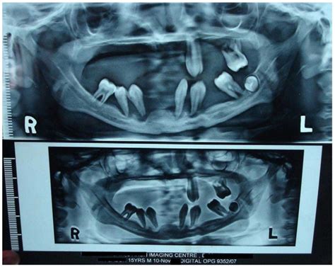 Panoramic Radiograph Showing Floating In Air Appearance Of Teeth