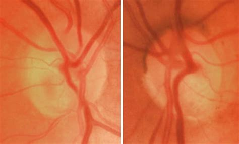 OPTOMETRY: Normal-tension glaucoma (NTG) | ProFile – Specsavers journal