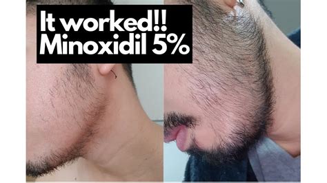 Minoxidil Beard Journey ⎮do We Grow Beard If We Use Minoxidil ⎮ Yes