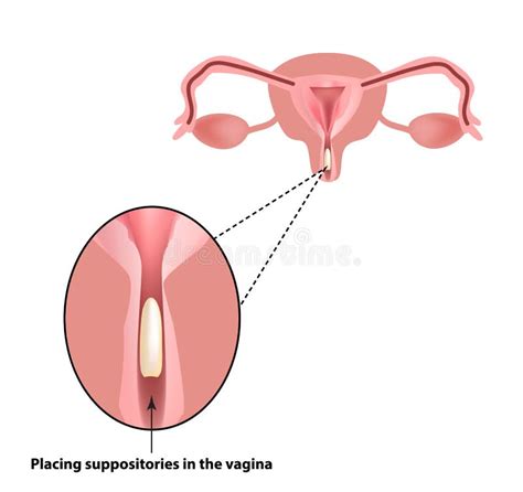 Trattamento Delle Supposte Di Vaginite Infiammazione La Vagina