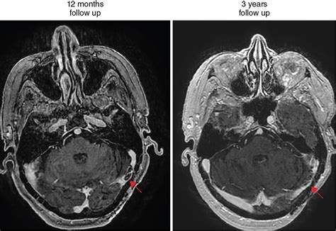 Transverse sinus dural arteriovenous fistula – upfront, preembolization radiosurgery | Radiology Key