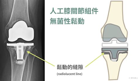 人工膝關節再置換手術：談人工膝關節出了問題怎麼修理｜蔡尚聞醫師